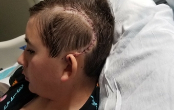 Levi's scar following brain surgery. scar on levis head