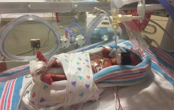 Birdie stayed in the NICU for more than three months Birdie stayed in the NICU for more than three months
