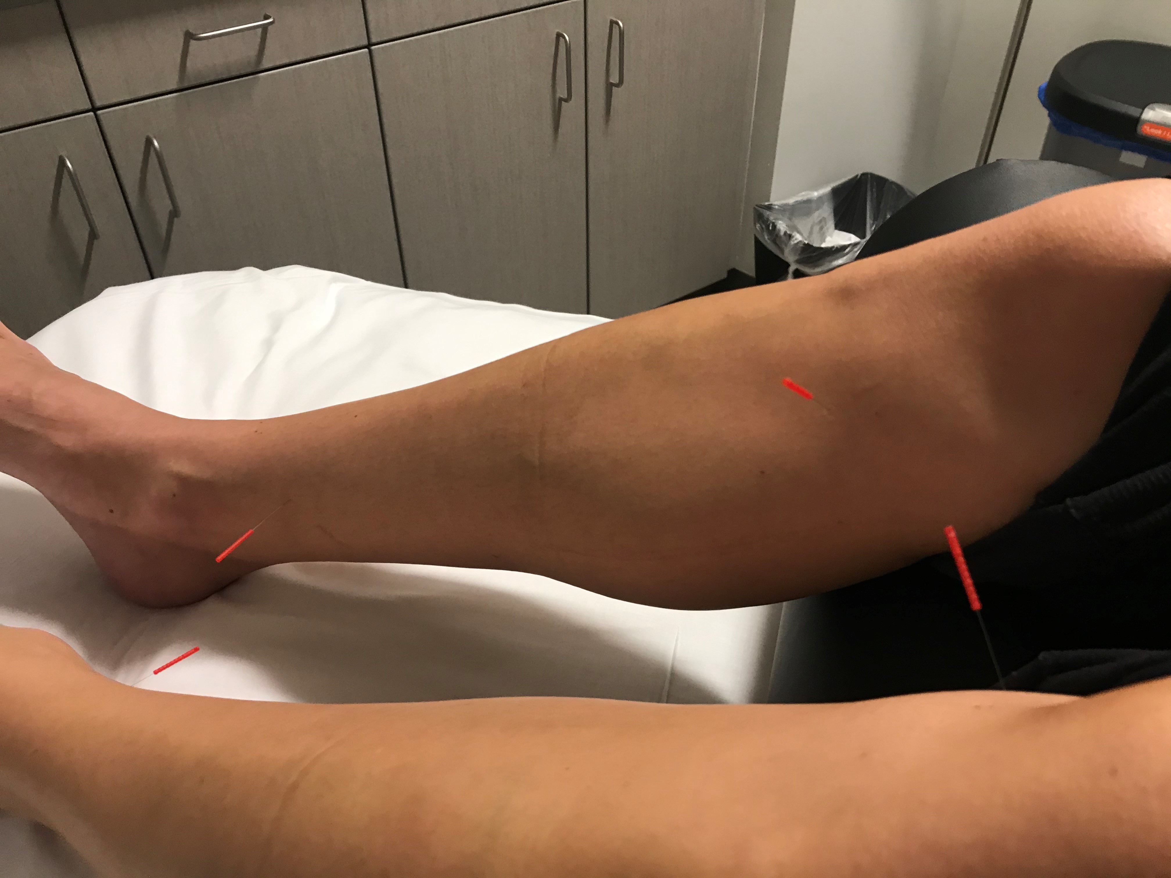 Acupuncture needles are thinner than a human hair. gina gets acupuncture