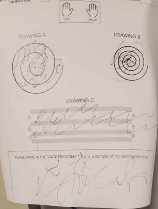 Larry Hicks' writing test before surgery Hicks BEFORE