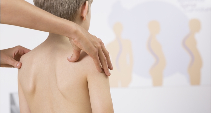 Scoliosis