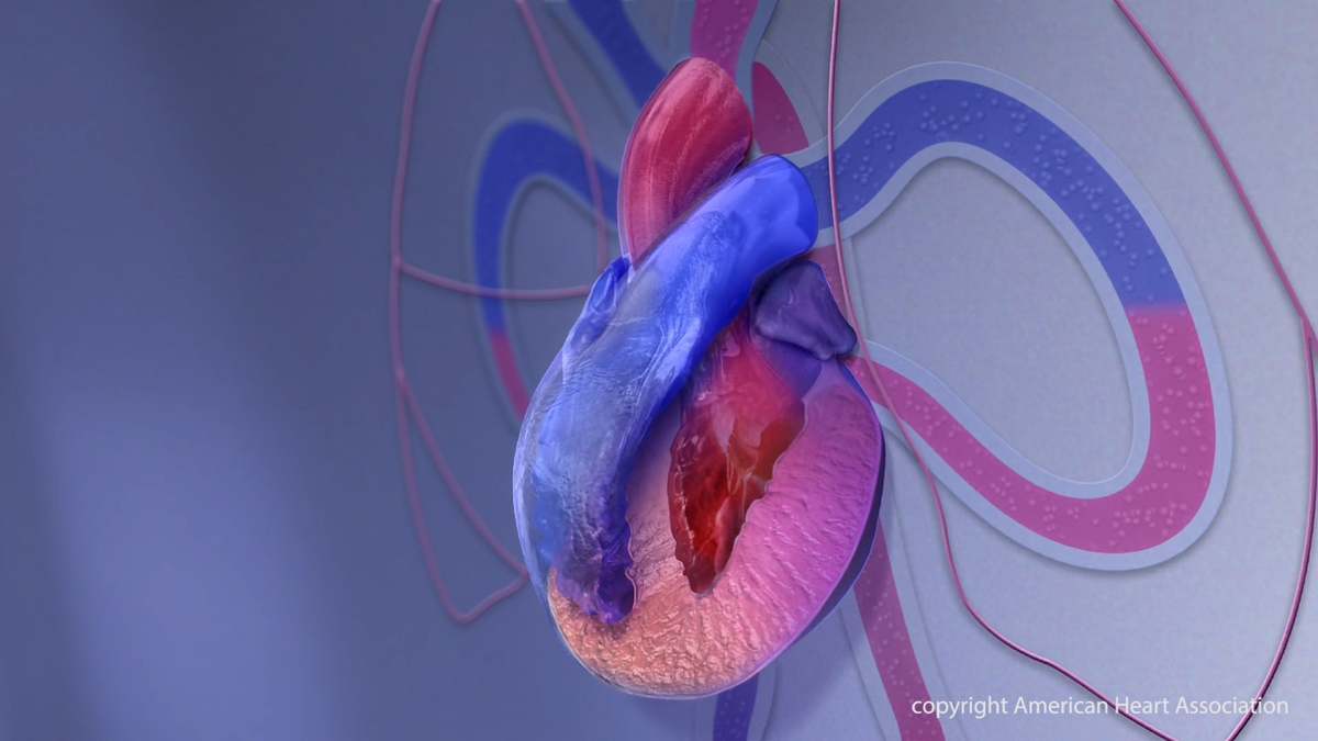 Advancing Access to Clinical Trials for Cardiomyopathy Advancing Access to Clinical Trials for Cardiomyopathy