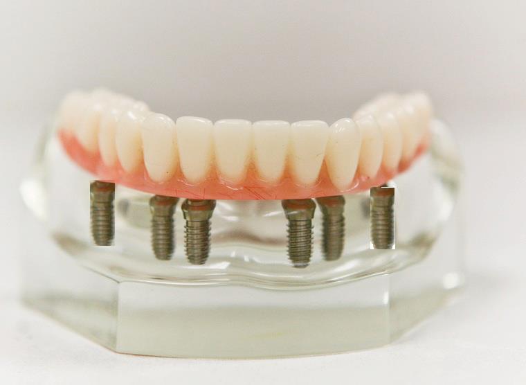 Implant Dentist Dental Implants