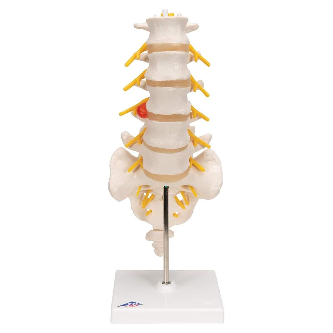 Columna Vertebral Lumbar 3B Scientific A76/5 con Disco Prolapsado 34 cm