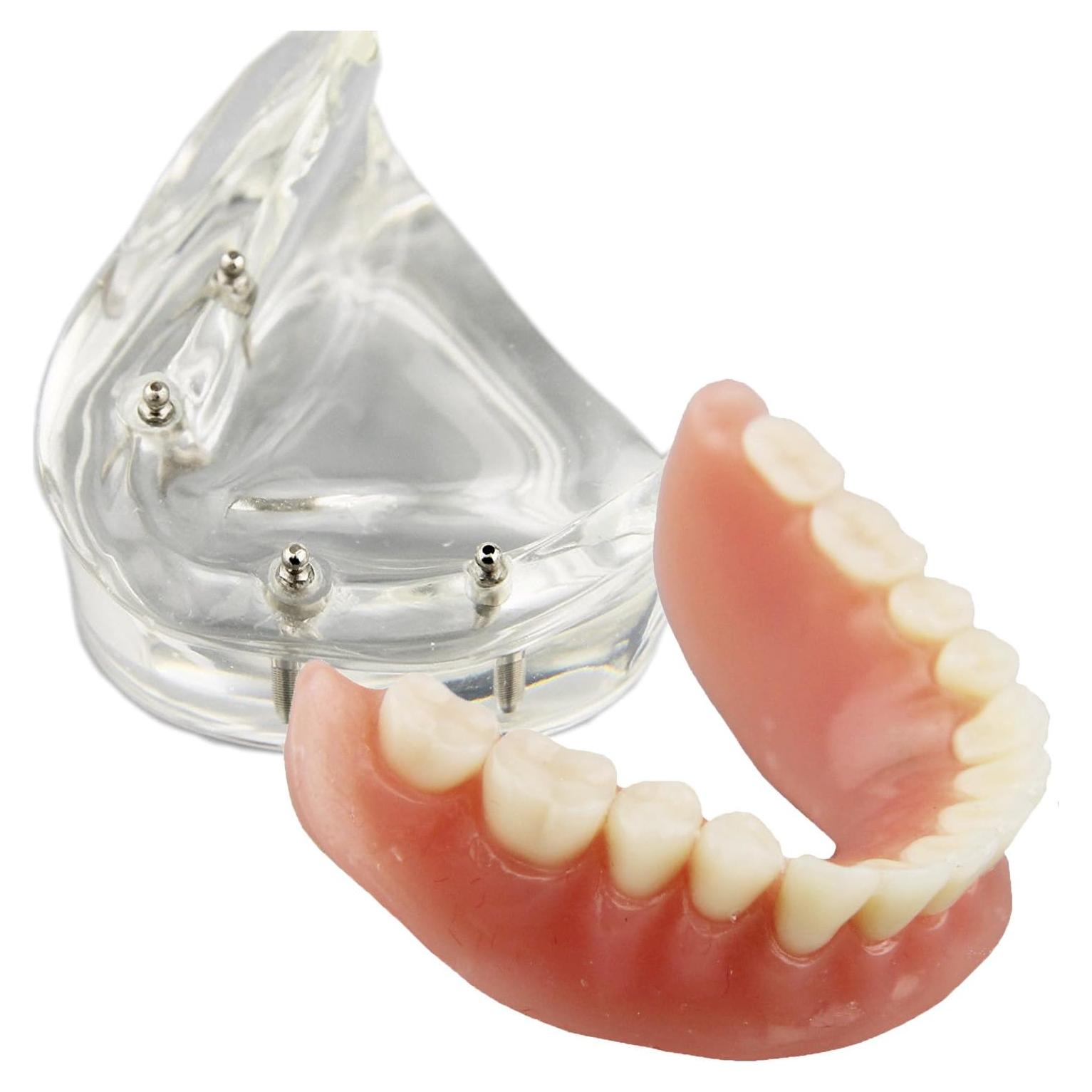 Modelo Dental Sobredentadura Inferior Smile1000 4 Implantes