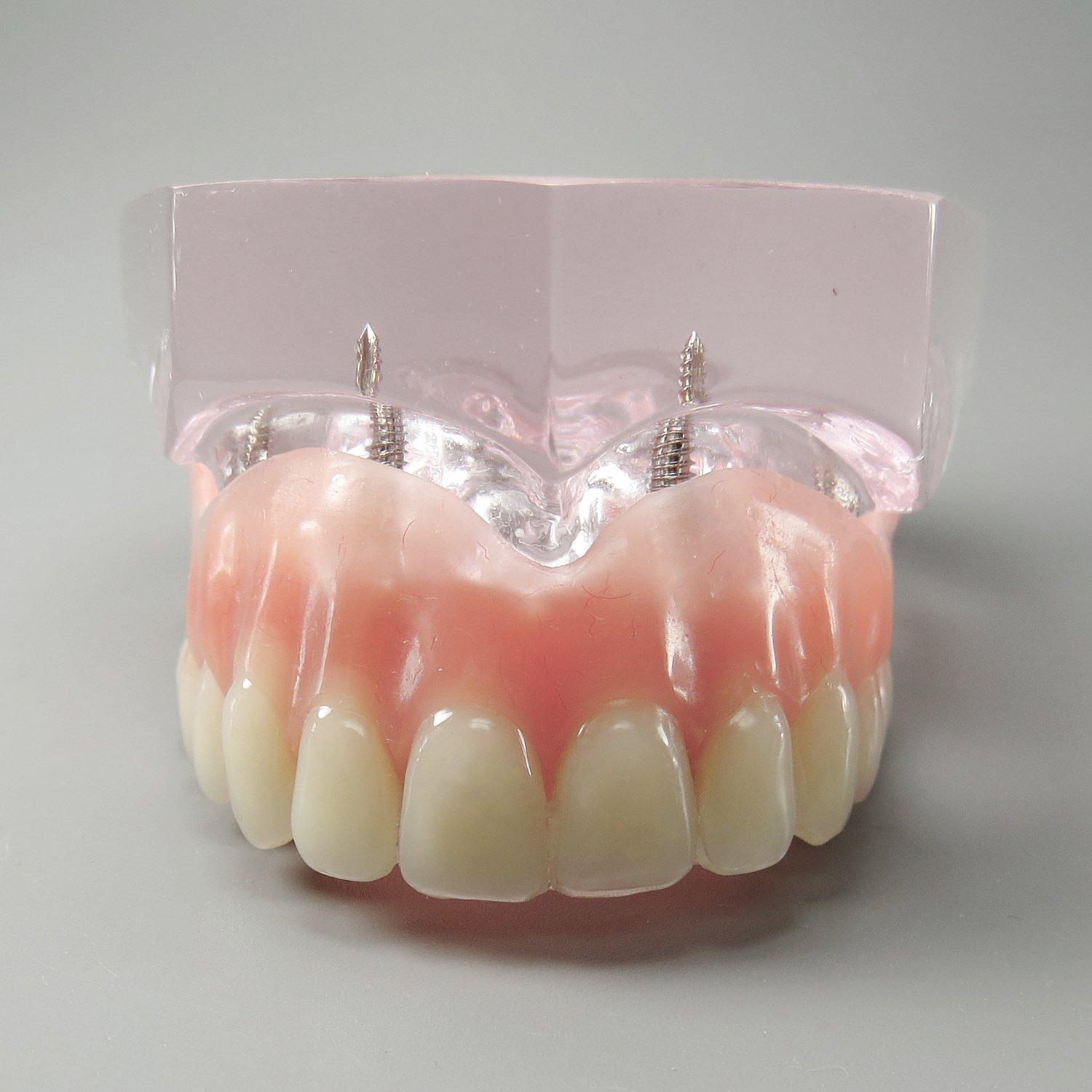 Modelo Dental Sobredentadura Superior Smile1000 4 Implantes