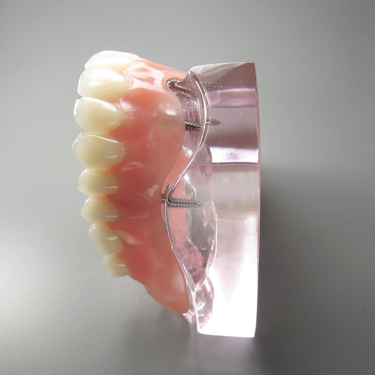 Modelo Dental Sobredentadura Superior Smile1000 4 Implantes