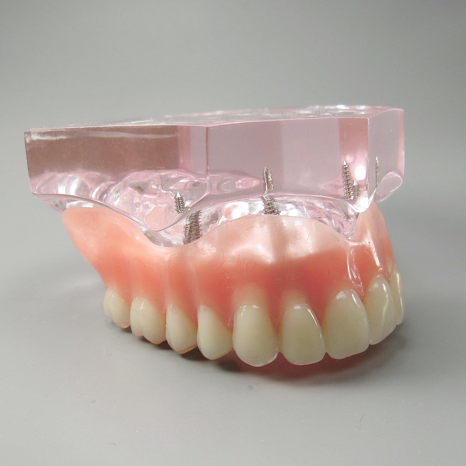 Modelo Dental Sobredentadura Superior Smile1000 4 Implantes