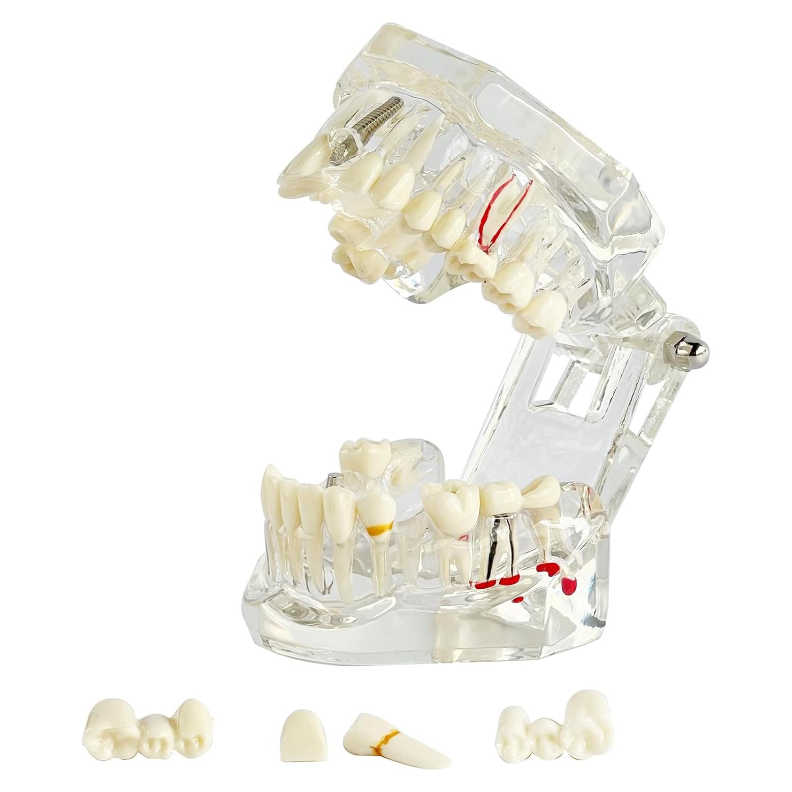 Modelo Dental Transparente Patológico Ceonam - Tamaño Real