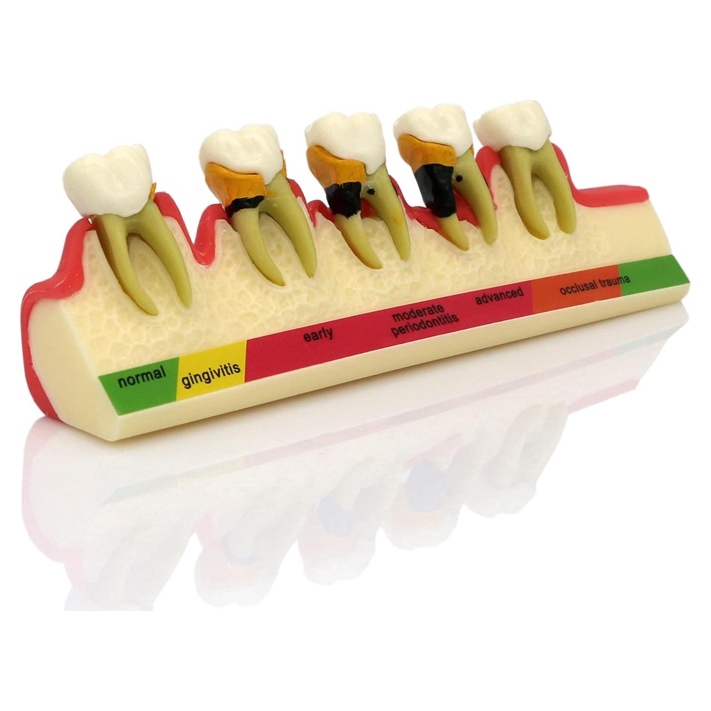 Modelo Typodont Dental M4010 para Enfermedad Periodontal