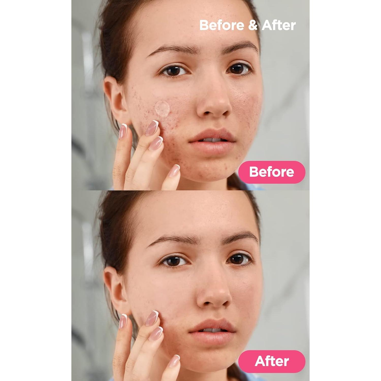 Dressing de Heridas Dermalogy Neogenlab A-Clear 12 Parches