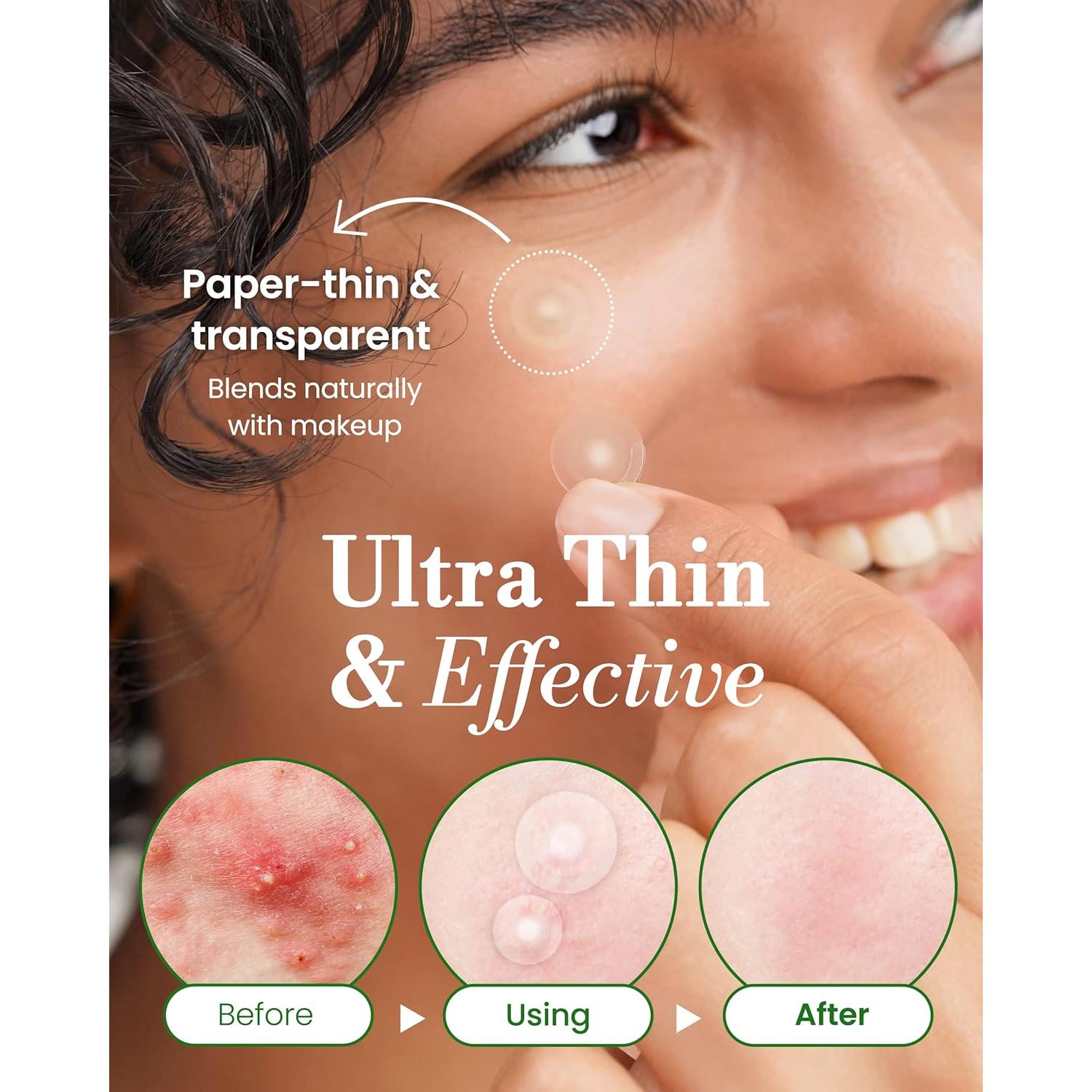 Parche Invisible para Granitos Troubless - 96 Unidades Hidrocoloides