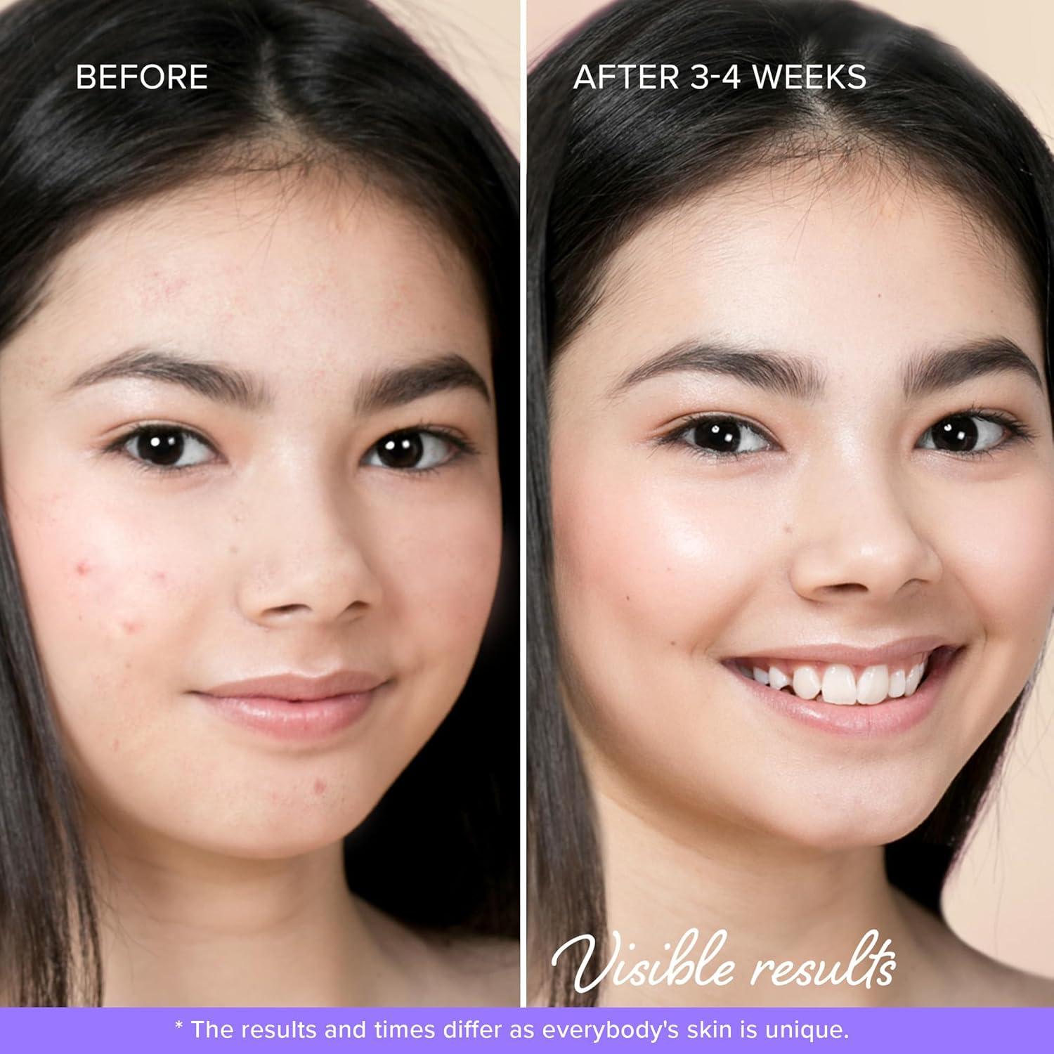 Parches para Acné MAREE Star - 72 Unidades Hidrocoloides