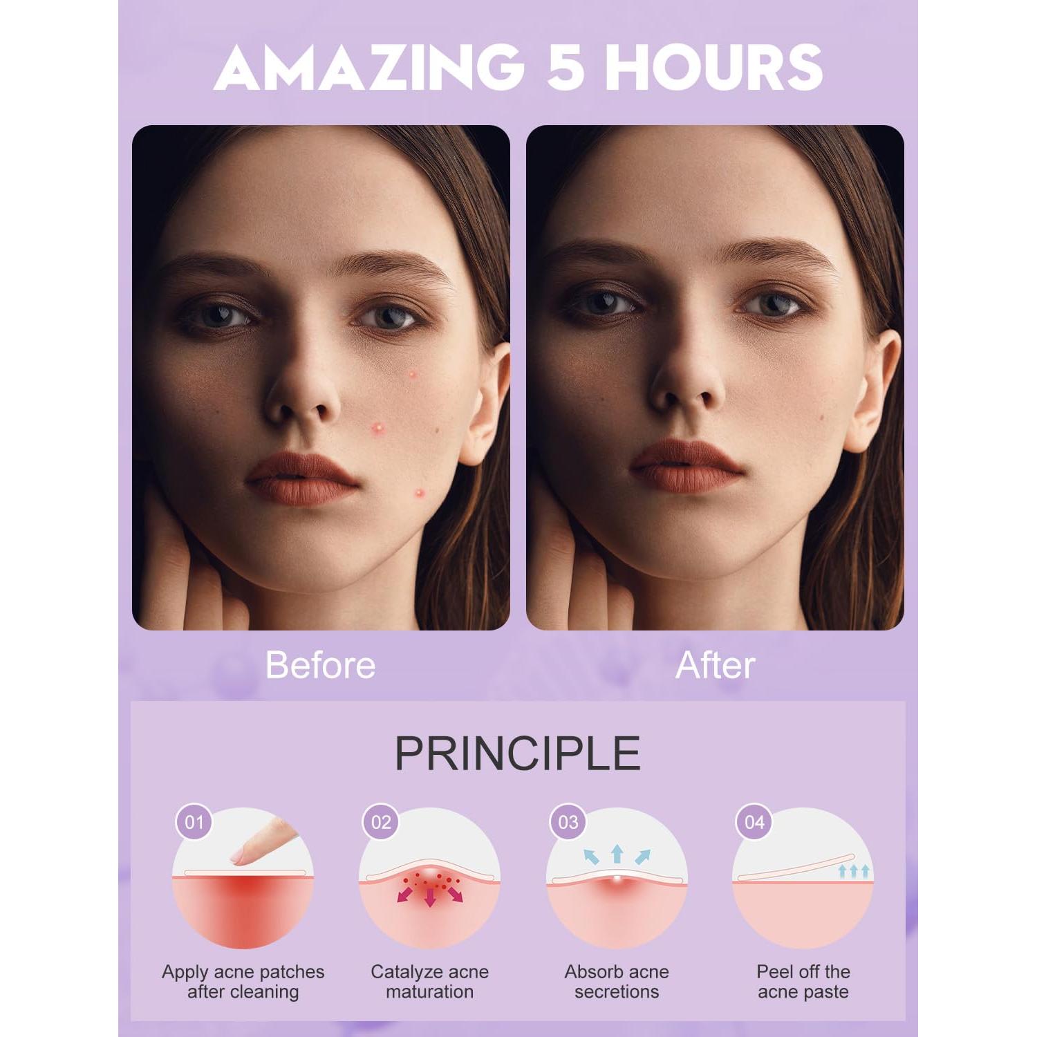 Parches para Granos WakeALL 108 Pcs Hidrocoloides 5 Tamaños