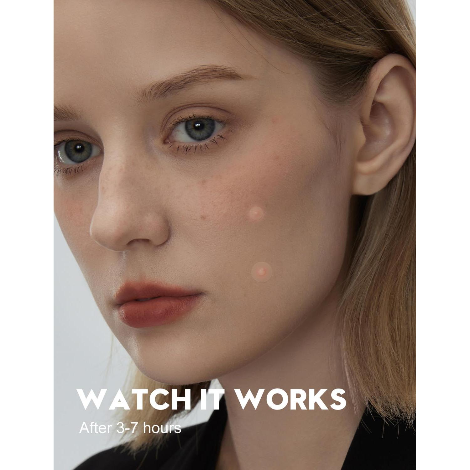 Parches para Granos WakeALL 108 Pcs Hidrocoloides 5 Tamaños