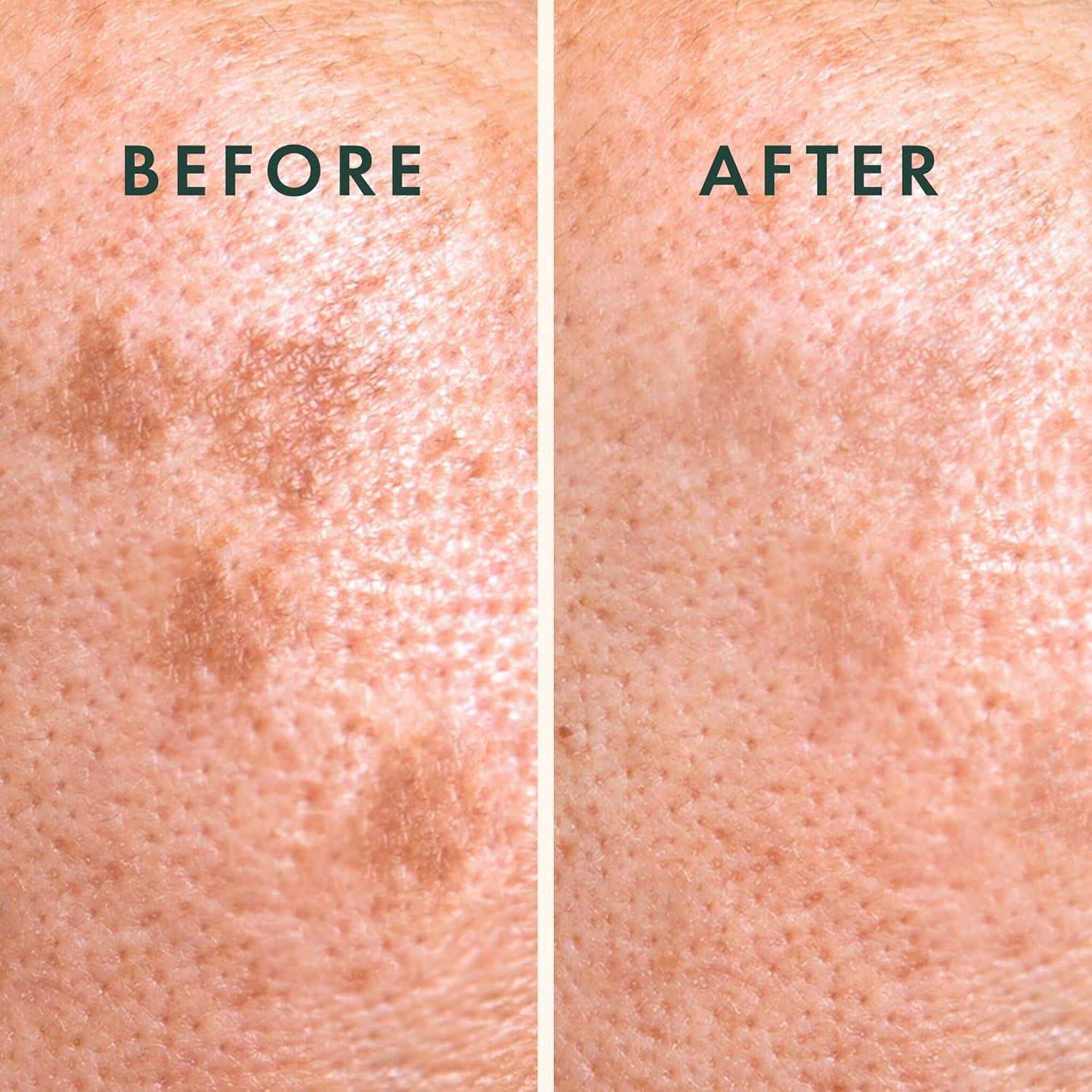 Parche Hidrocoloide Rael para Manchas Oscuras - 9 Unidades