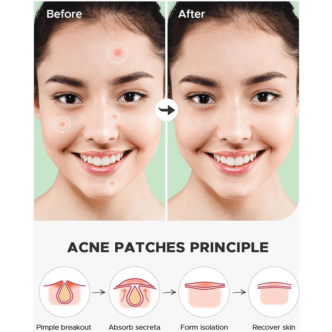 Parche para Granos de Acné ZATKTK - 180 Unidades, 4 Tamaños