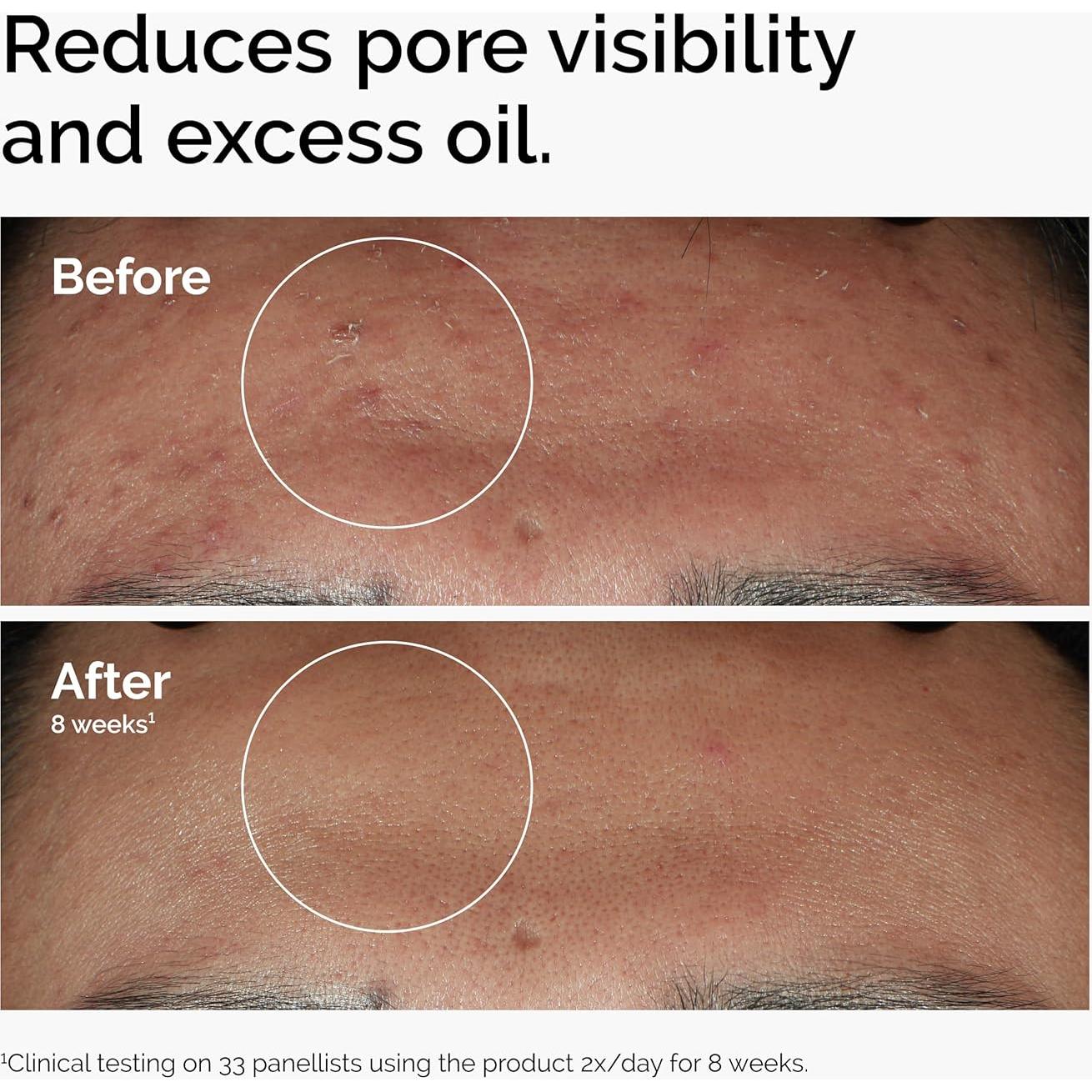 Conjunto de Sérums The Ordinary - Ácido Hialurónico, Niacinamida y Cafeína