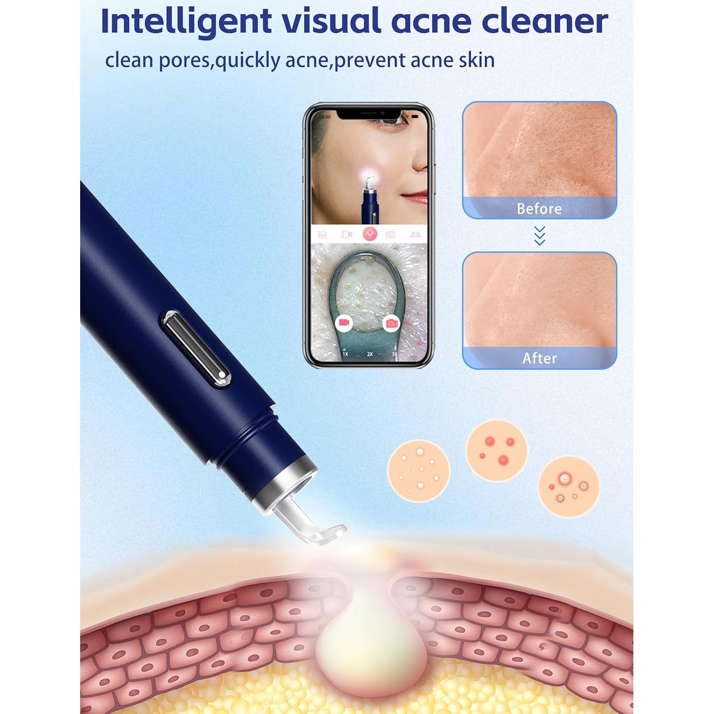 Extractor de Puntos Negros con Cámara 20X Shenmai - Limpiador de Poros