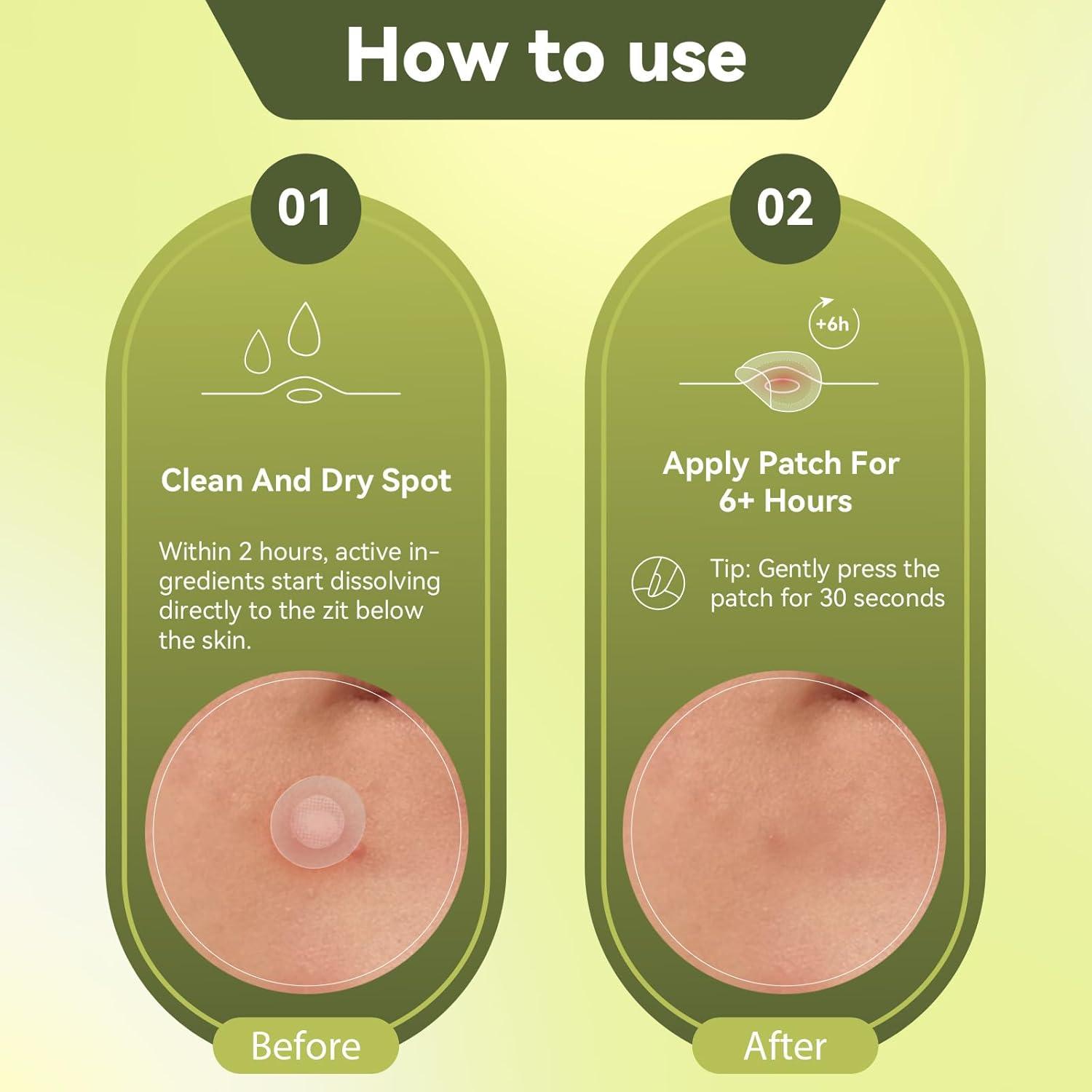 Parche para Acné Naterido Microdart 24 Piezas Ácido Hialurónico
