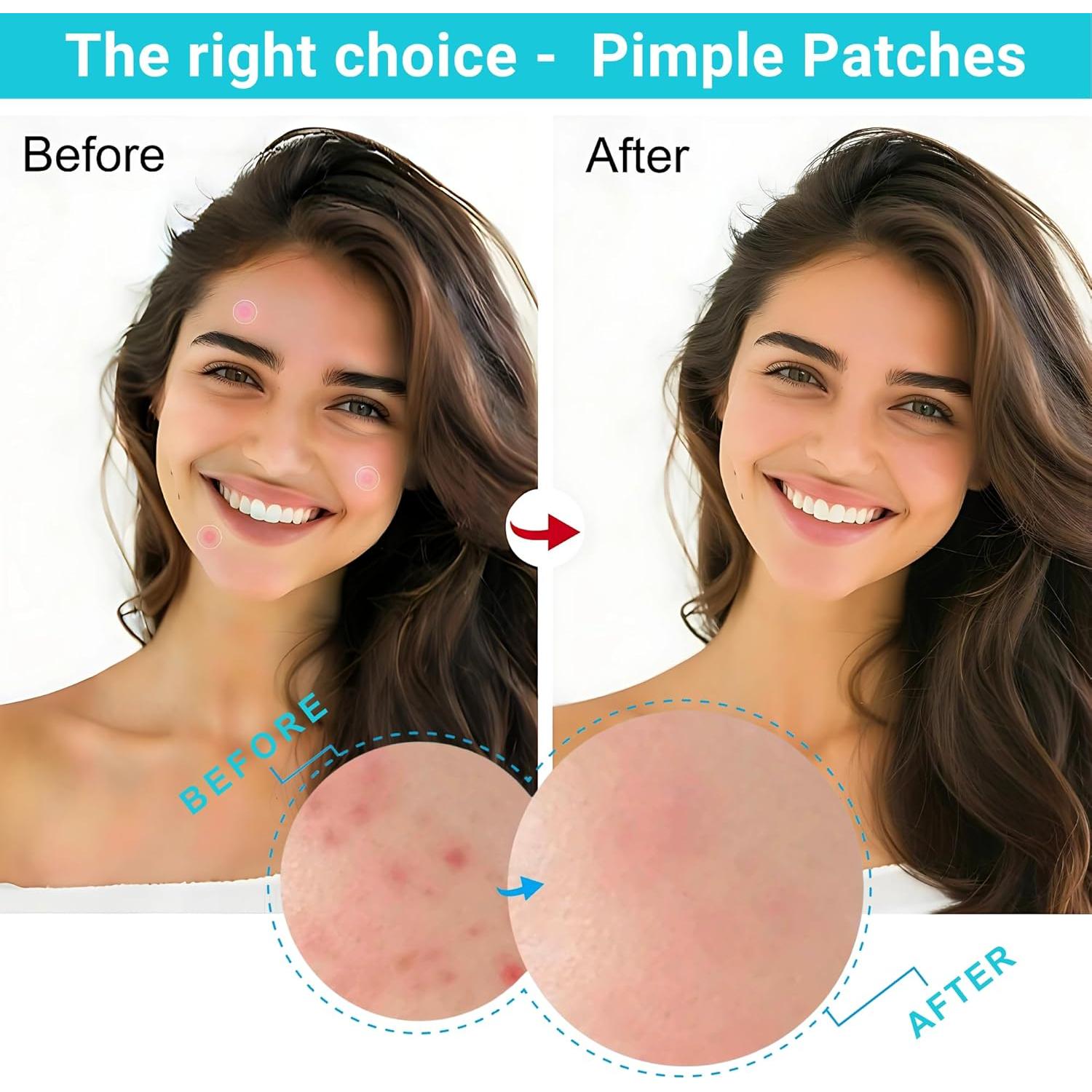 Parche Hidrocoloide SpotlessX para Acné - 96 Parches, 3 Tamaños