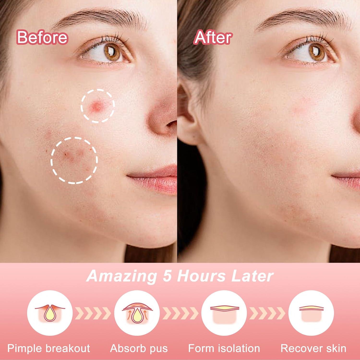 Parche para Granos CELECARE - 330 Piezas, 4 Tamaños, Hidrocoloide