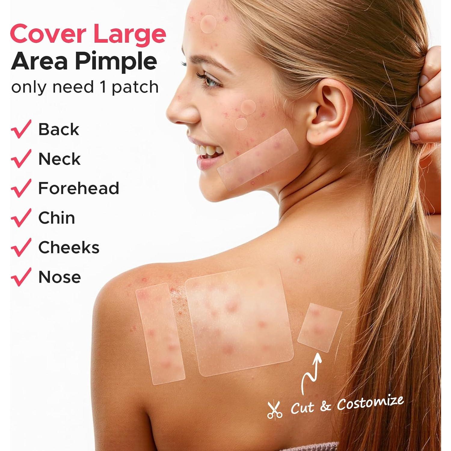 Parches para Granos LitBear - 212 Cuentas, 5 Tamaños, Hidrocoloide