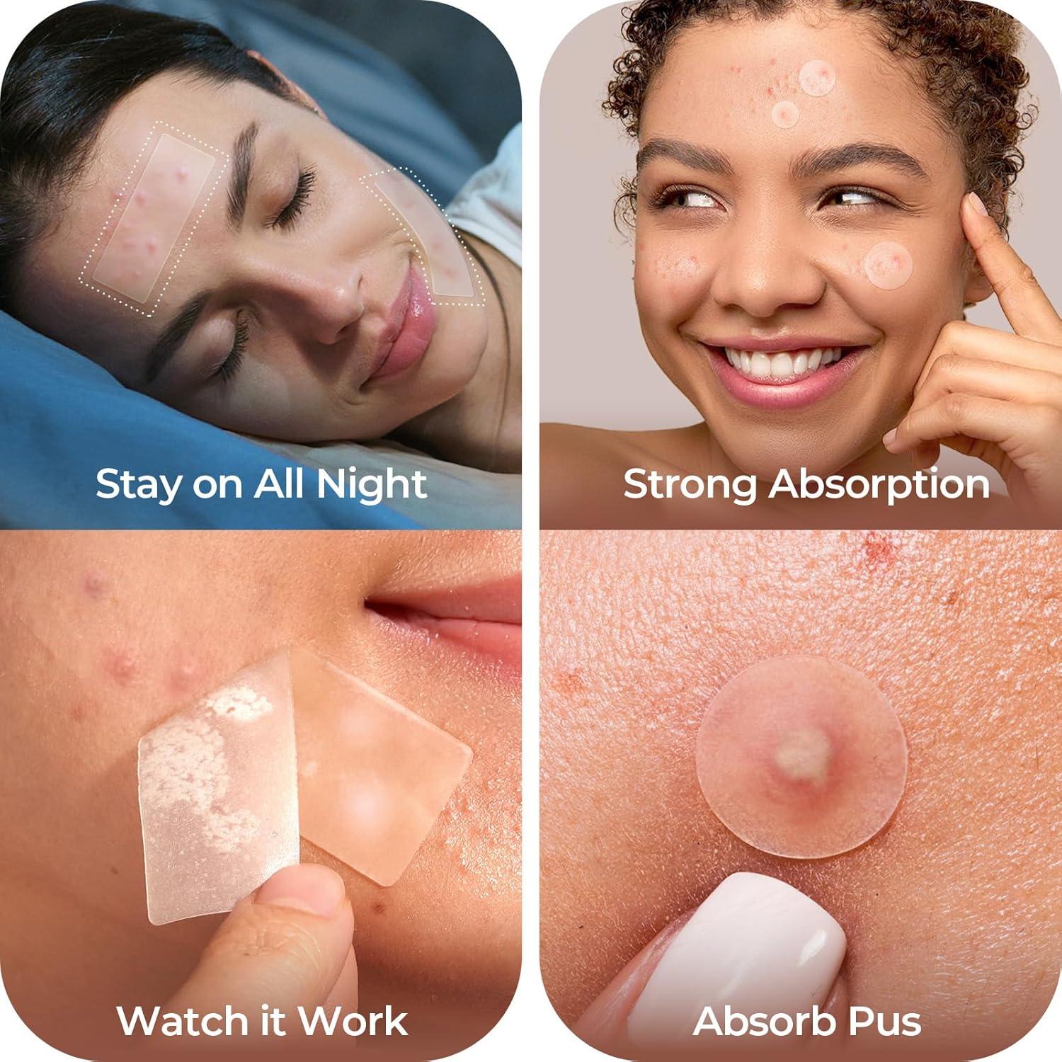 Parches para Granos LitBear - 212 Cuentas, 5 Tamaños, Hidrocoloide