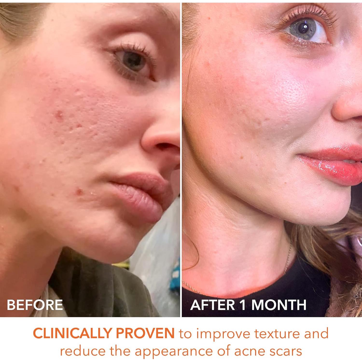 Peeling Diario Dr. Dennis Gross 5 AHA/BHA - 5 Tratamientos