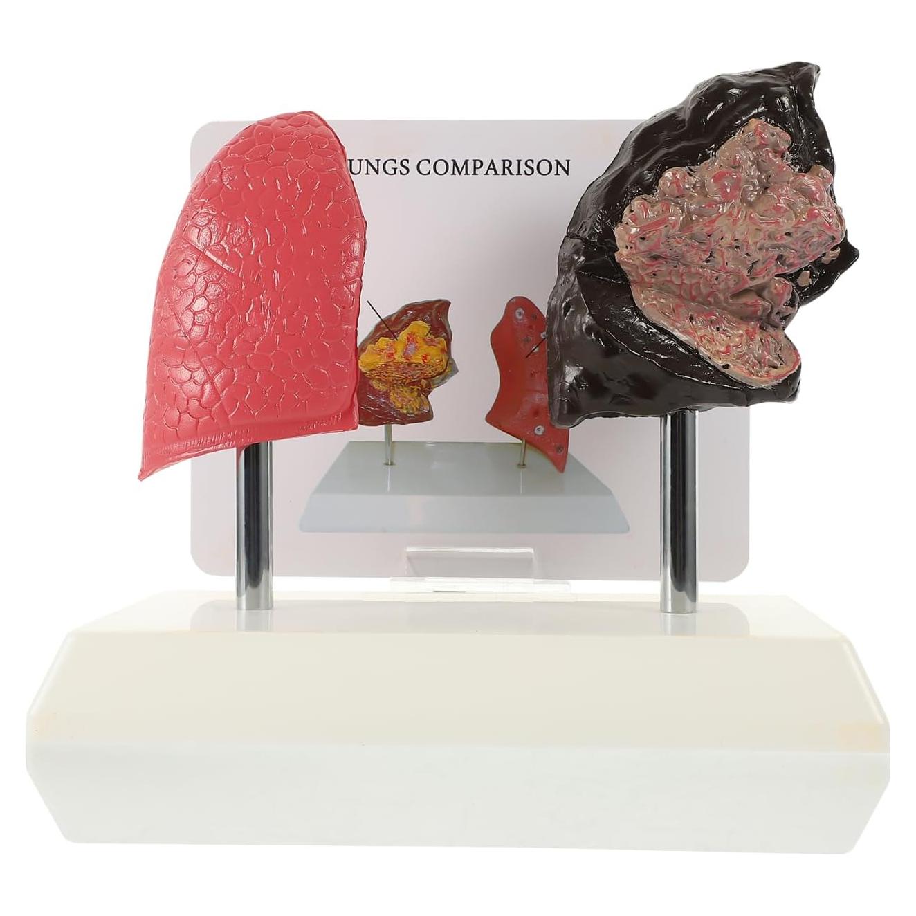 Modelo de Pulmón Fumador Cabilock - Anatomía Realista PVC 20cm