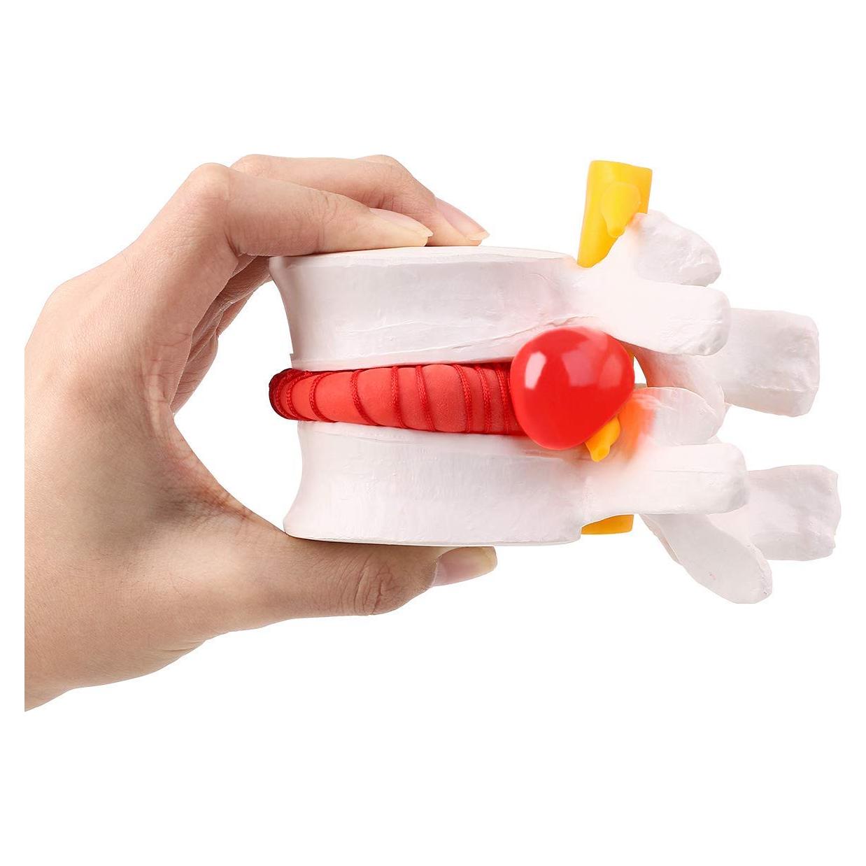 Modelo de Herniación del Disco Lumbar Humano YOOVEE 24 cm