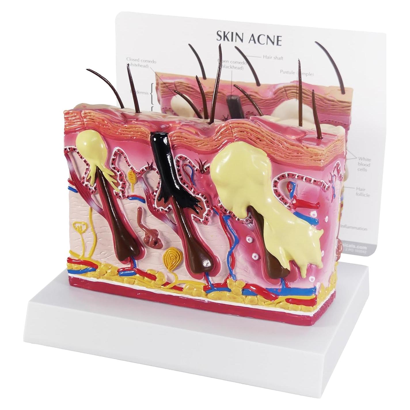 Modelo Anatómico de Acné GPI Anatomicals 15.24x15.24 cm