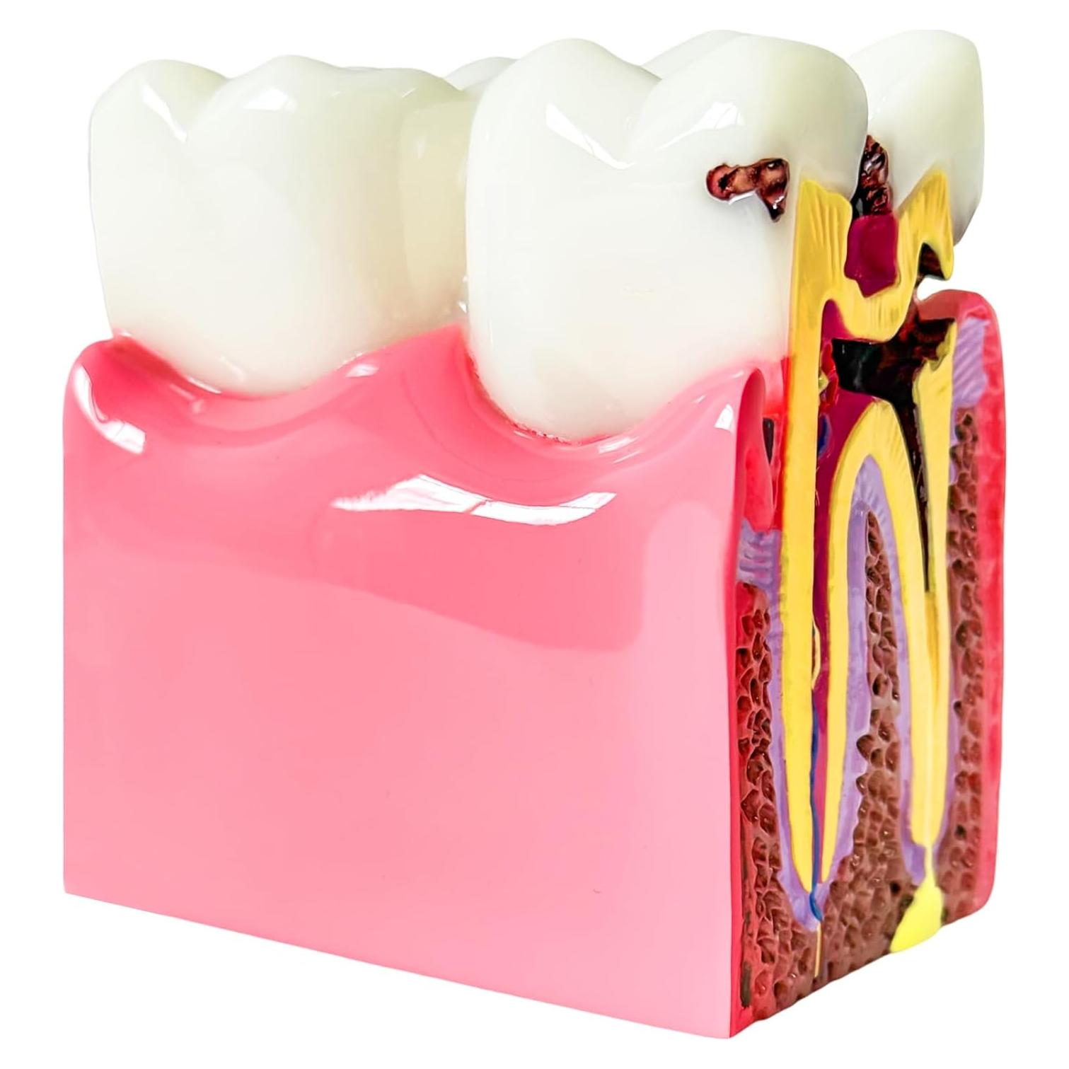 Modelo Educativo de Dientes de Caries Ceonam 8.6x7.6cm