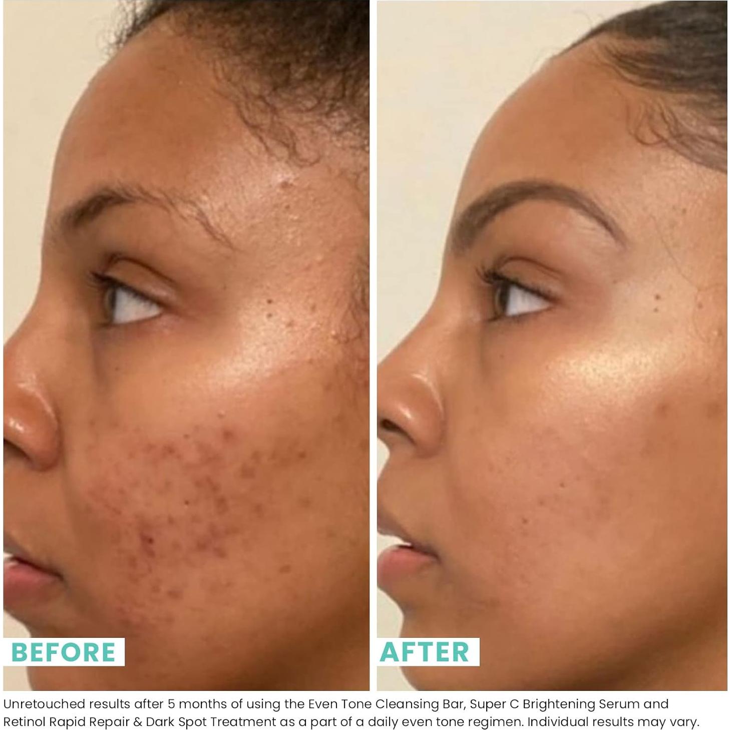 Barra Limpiadora Urban Skin Rx Even Tone 56.7 g - 3 en 1