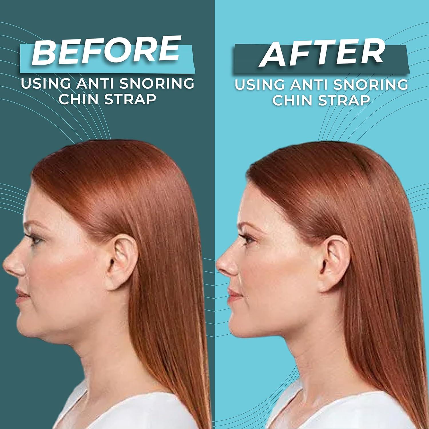 Correa de Barbilla Antironquidos Massner - Ajustable y Transpirable