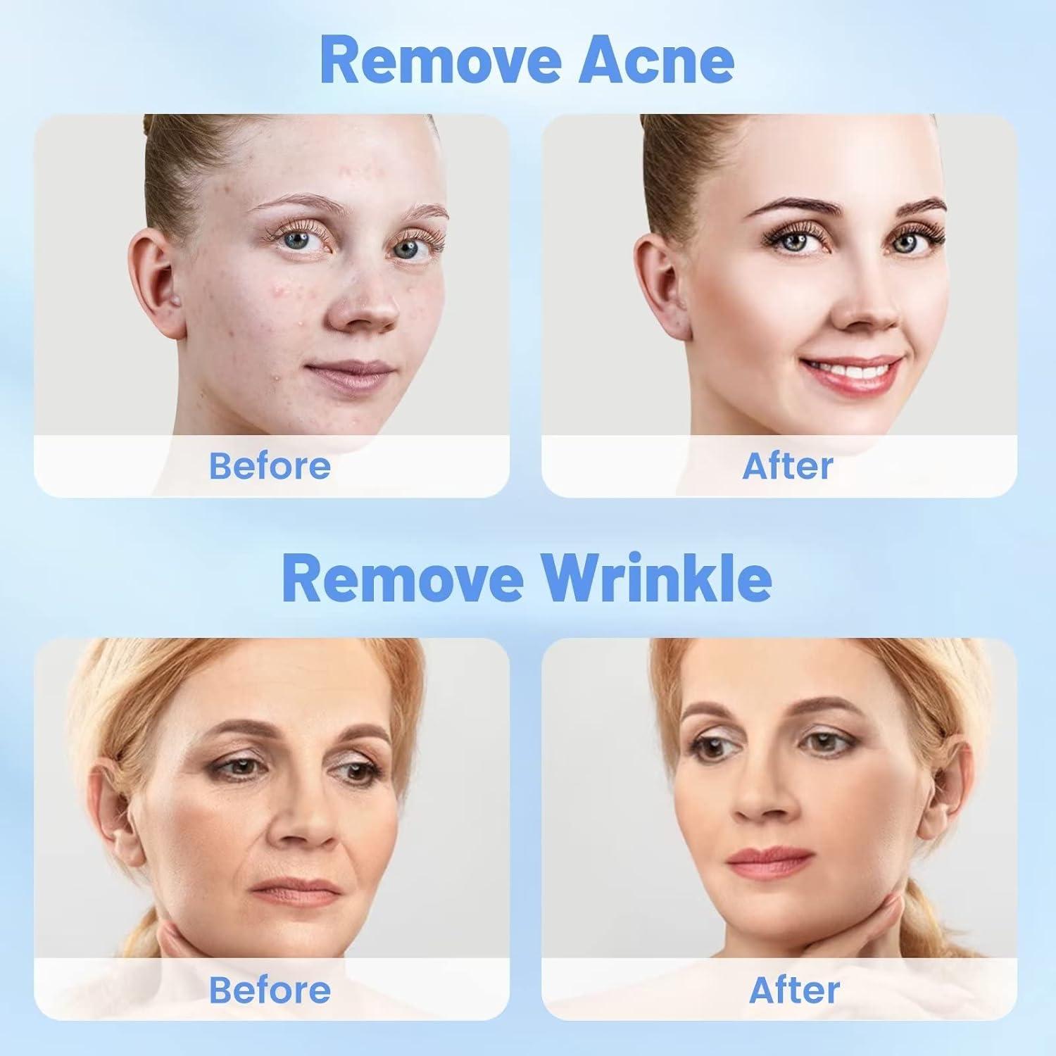 Máquina de Microdermoabrasión 5 en 1 Mcwdoit Facial Profesional