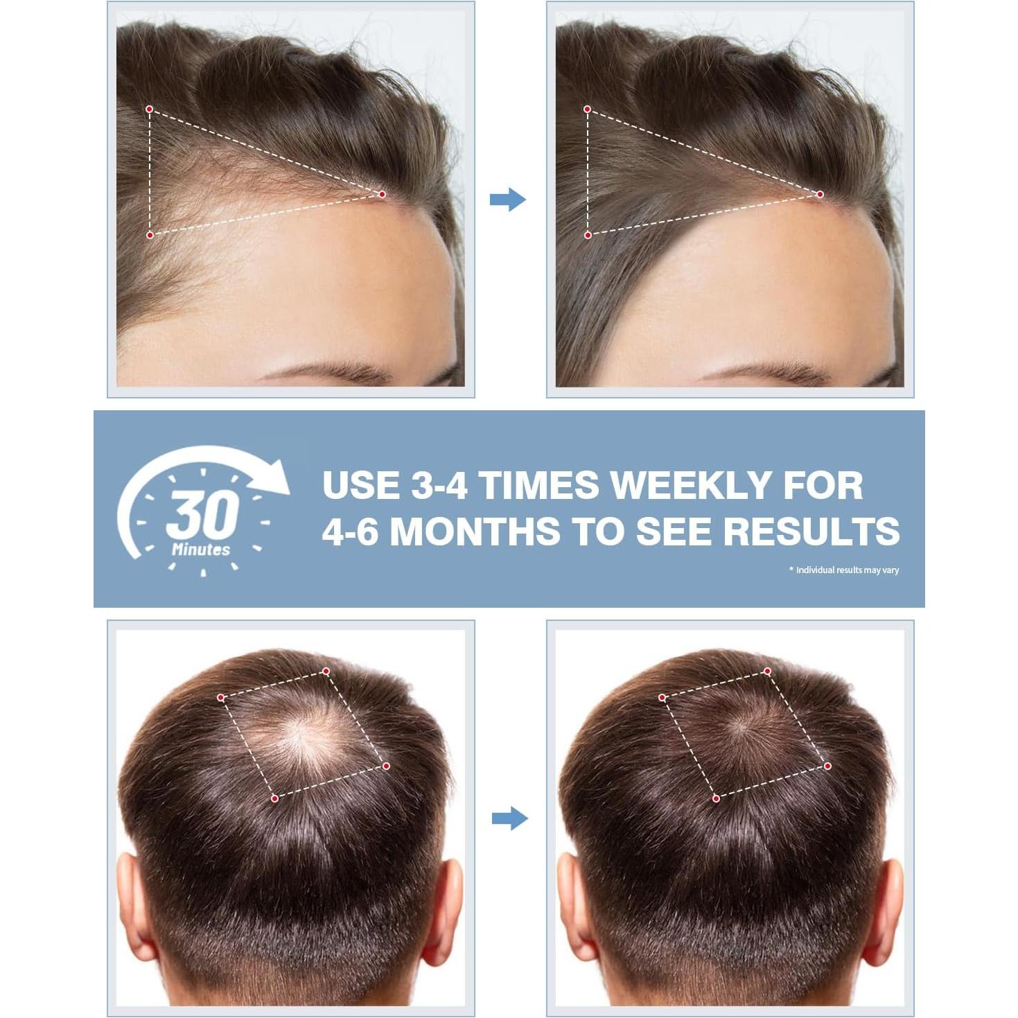 Gorro de Terapia de Luz Roja LONLIKE con Temporizador 630nm 850nm