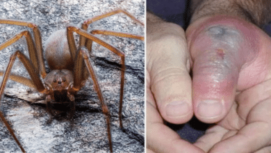 Piquete de araña violinista: ¿Cómo identificarla y qué hacer si te pica?