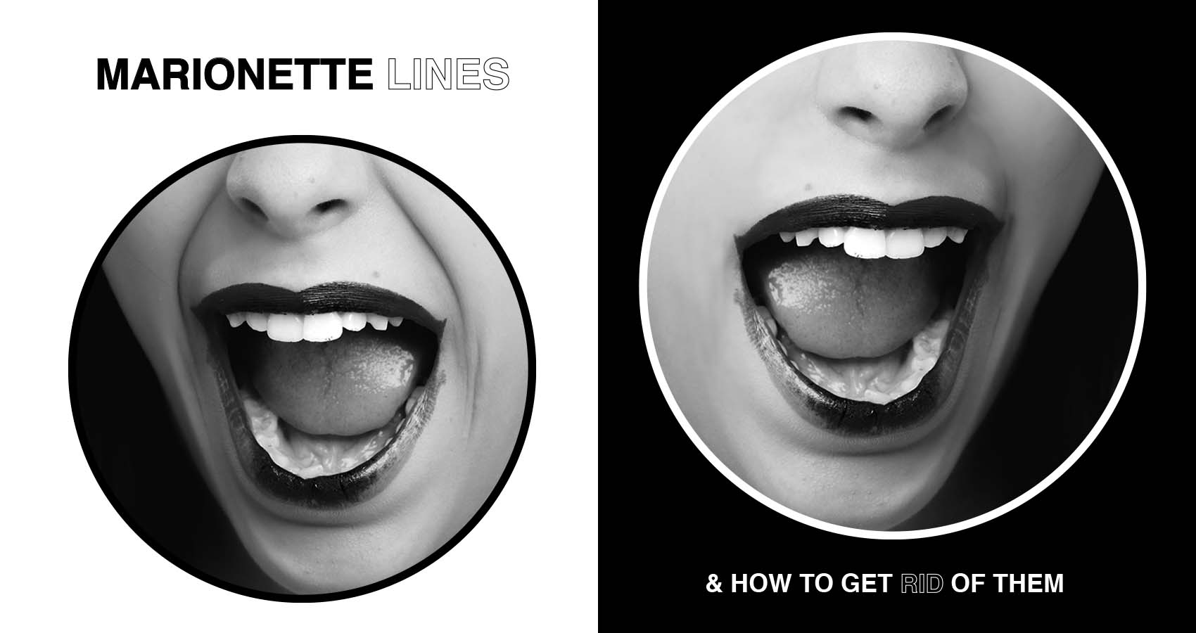 Marionette Lines: How to Get Rid of Them Marionette Lines: How to Get