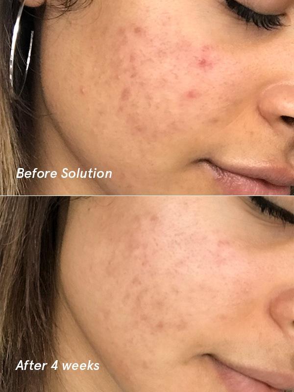 If You Suffer From Acne, This Might Be The Solution You Need