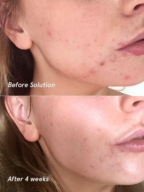 If You Suffer From Acne, This Might Be The Solution You Need