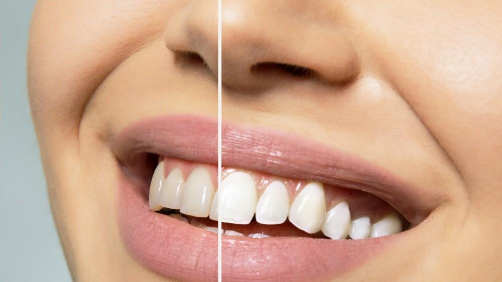 Laser Teeth Whitening: Is It Worth the Hype?