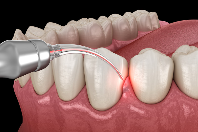 Dental Laser Therapy: A Pain-Free Solution for Dental Procedures?
