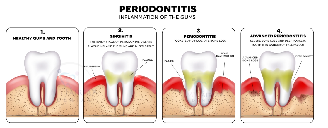 Understanding the Stages of Gum Disease and Their Treatments