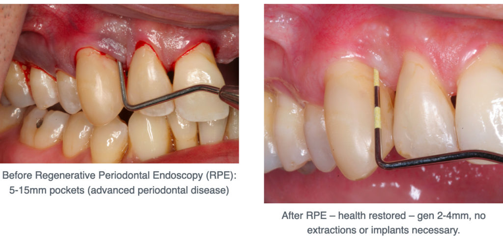 The Cost of Periodontal Treatment: What to Expect and Insurance Coverage
