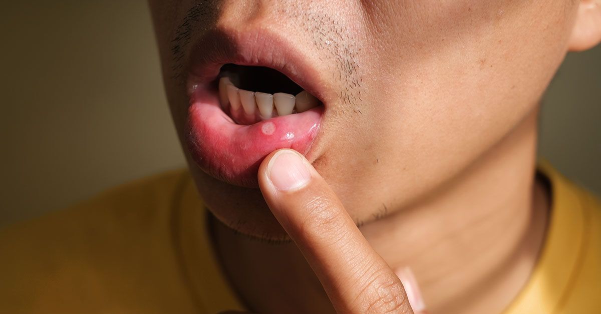 Oral Care Tips for Patients with Recurrent Mouth Ulcers