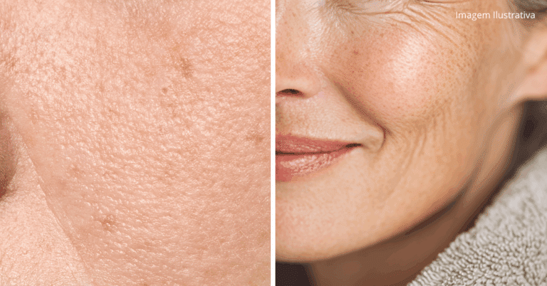 Comparativo de pele com poros dilatados e pele com textura mais uniforme, ilustrando os resultados do uso de creme com ação de sérum para minimizar poros e melhorar a aparência da pele