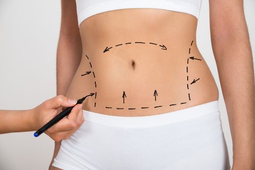 liposuction stomach
