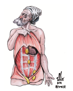 Cover of C2: Hernias