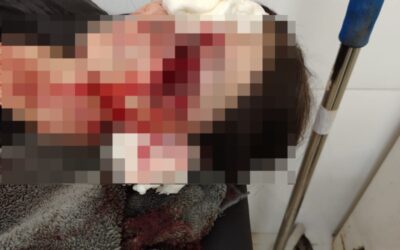Mujer quedó con el rostro desfigurado tras salvaje ataque de su perro